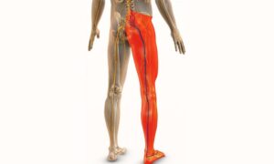 साइटिका दर्द का इलाज